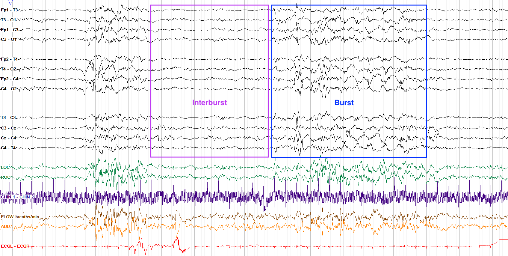 EEG in Newborn: Definition, Examples, and Facts Explained 1 eeg in newborn definition examples and facts
